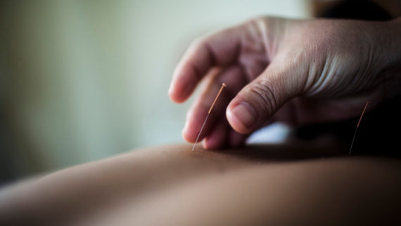 acupuncture for infertility